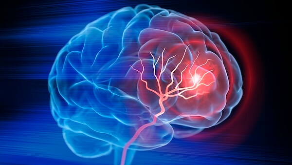 A digitally image depicting a stroke in a human brain.